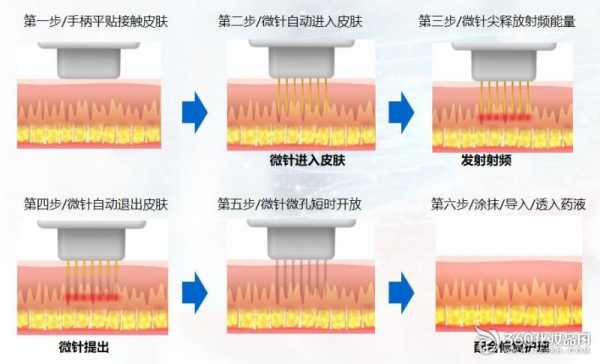 什么是针雕微整（针雕美容的原理）