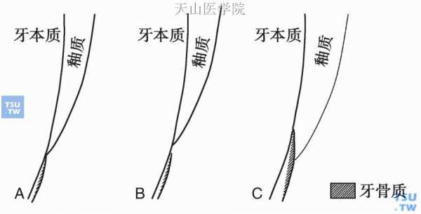 釉牙本质界是什么（釉牙本质界的形态特点）