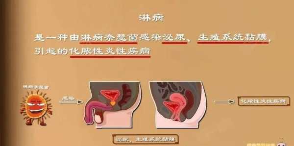 淋病主要通过什么传染（淋病主要通过什么传染给别人）