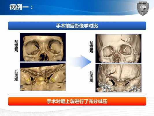 眶上裂有什么通过（眶上裂由什么围成）