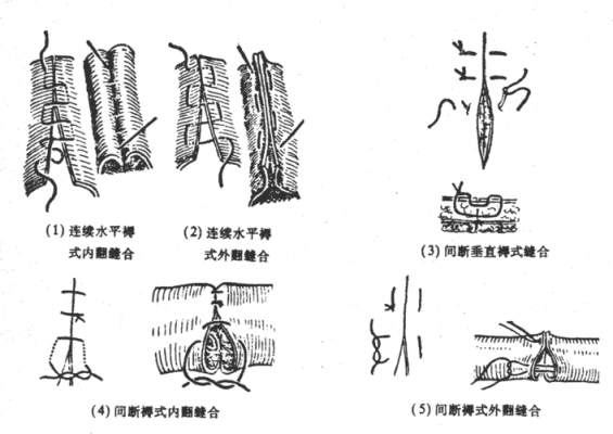 什么是延期缝合（延期缝合的时间和条件）