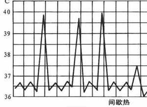 间歇热鉴于什么病（间歇热怎么治疗）