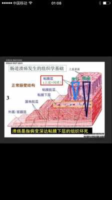 累及被膜什么意思（累及黏膜肌层是什么意思）