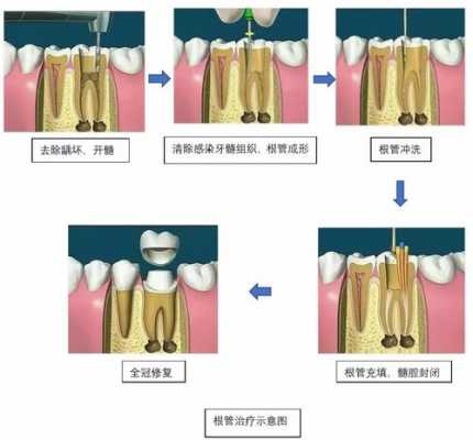 什么是干髓术（干髓术的操作步骤）