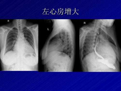 左心房增大有什么表现（左心房增大有什么表现症状）