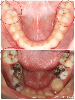 牙釉质龋是什么变化（牙釉质龋是什么变化引起的）